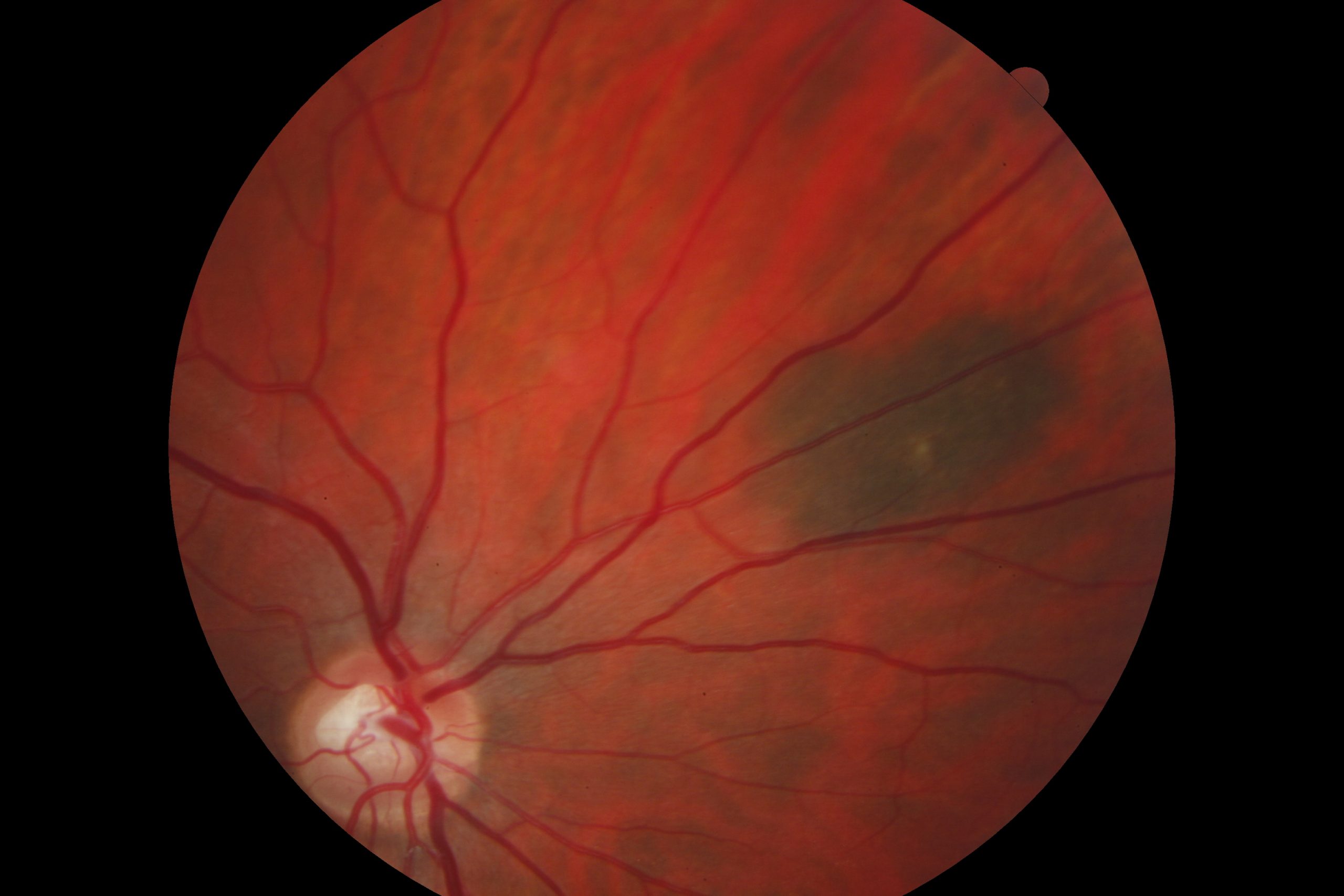 choroidal pigmentation icd 10